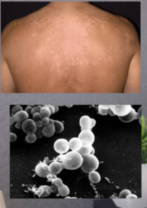 Skin Types Most Affected