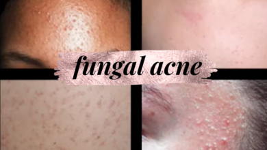 Fungal Acne: Causes, How It Looks, Fungal vs Acne & Treatment
