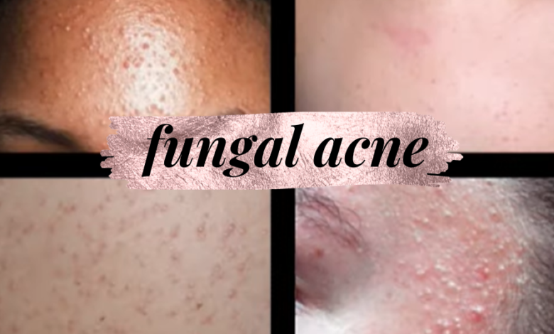 Fungal Acne: Causes, How It Looks, Fungal vs Acne & Treatment